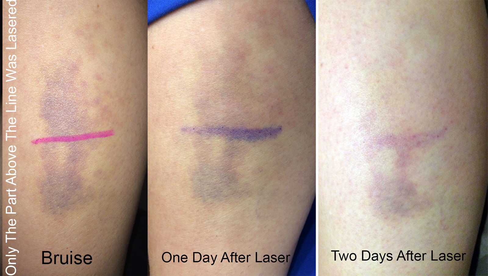 laser-that-gets-rid-of-bruises