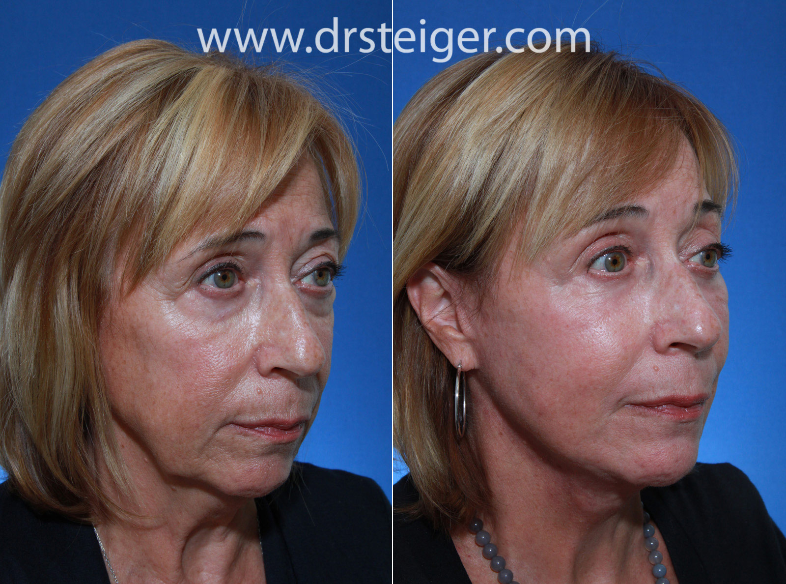 Blepharoplasty Eyelid Surgery Photos Before and After