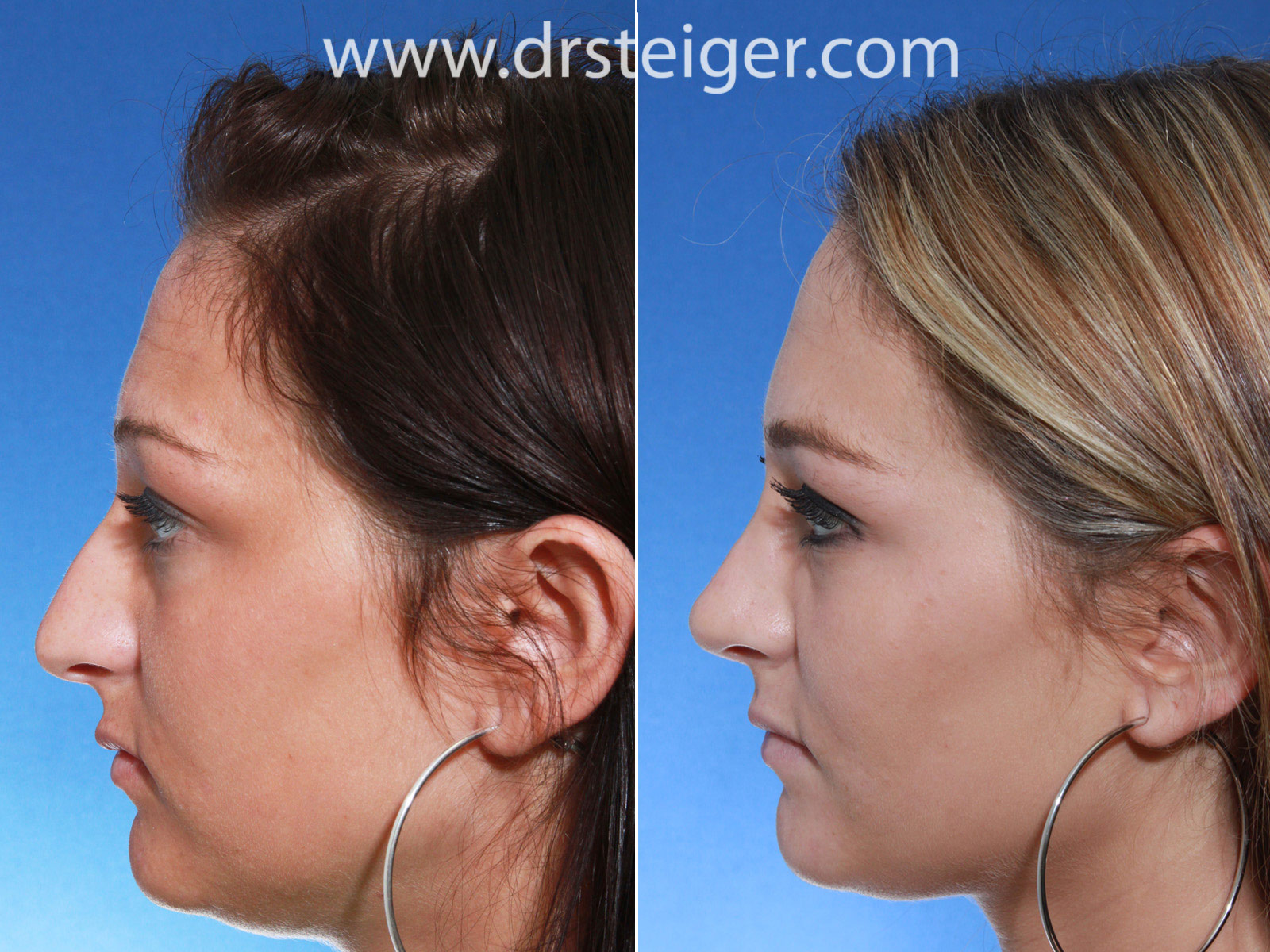 Nose Job (Rhinoplasty) Pictures of a Female